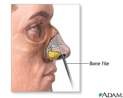 Procedure