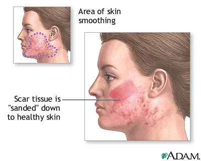 Procedure