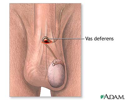 Incision
