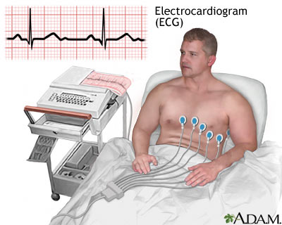 ECG