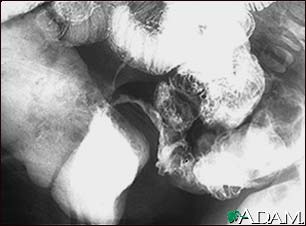 Crohn's disease, X-ray