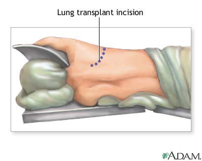Incision