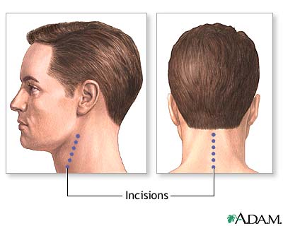 Incision