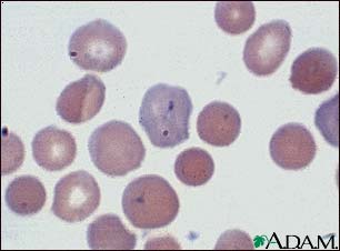 Malaria, microscopic view of cellular parasites