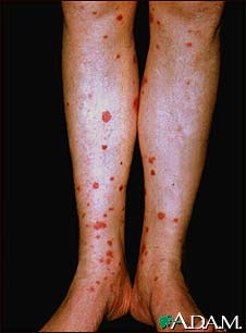 Henoch-Schonlein purpura on the lower legs