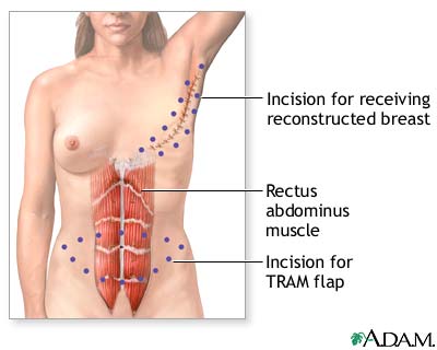 Incision