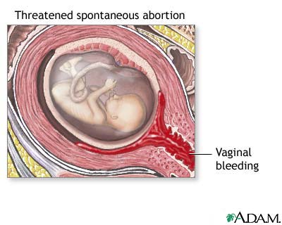 Miscarriage