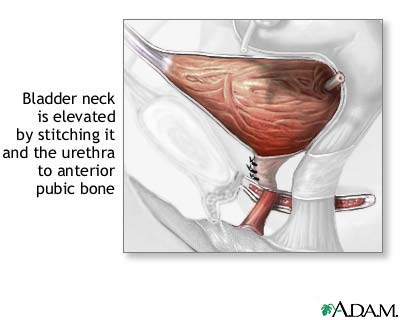 Stress incontinence