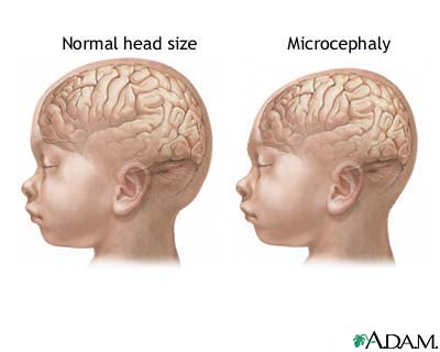 Microcephaly