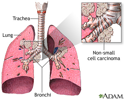 Large cell carcinoma