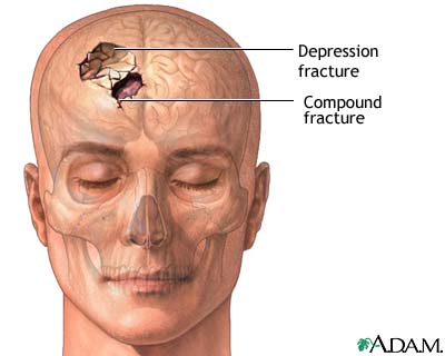 Skull fracture