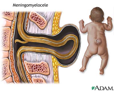 Spina bifida (degrees of severity)