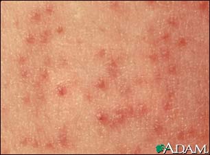 Keratosis pilaris - close-up