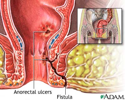 Anorectal fistulas