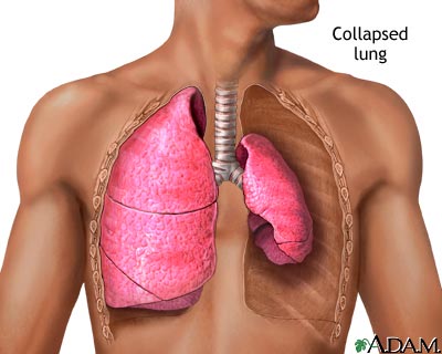 Collapsed lung, pneumothorax