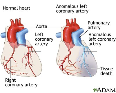 Anomalous left coronary artery