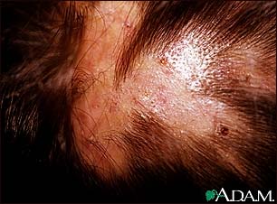 Folliculitis, decalvans on the scalp