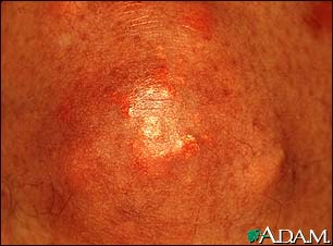 Xanthoma - close-up