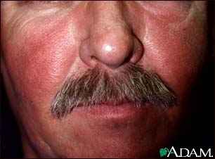 Systemic lupus erythematosus rash on the face