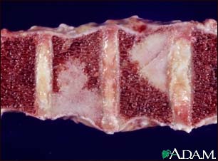 Spinal tumor