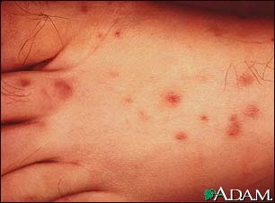Rocky mountain spotted fever on the foot