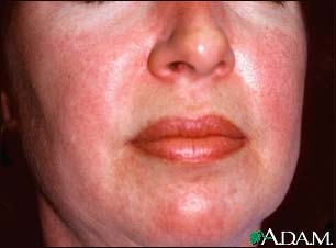 Dermatomyositis, heliotrope rash on the face