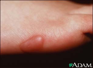 Keloid, on the foot