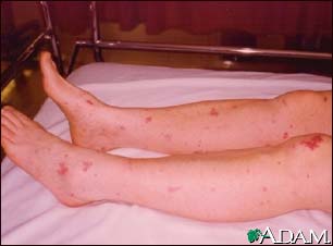 Meningococcemia associated purpura