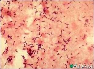 Pneumococcal pneumonia