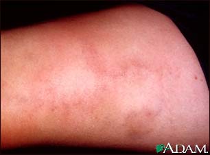 Superficial thrombophlebitis