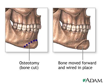 Procedure