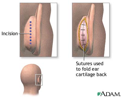 Procedure