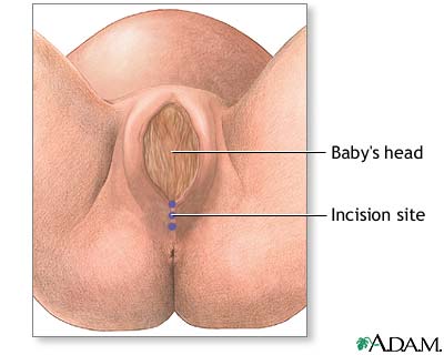 Indication