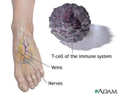 Diabetic foot care