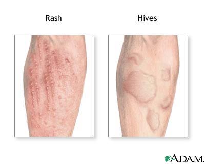 Allergic reactions