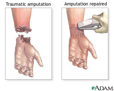 Amputation repair