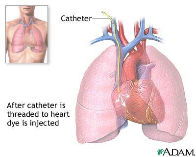 Cardiac catheterization