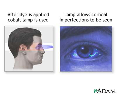 Florescent eye test