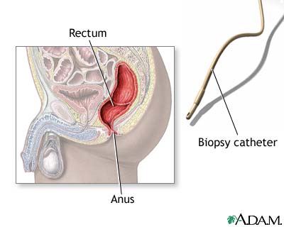 Rectal biopsy