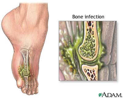 Osteomyelitis
