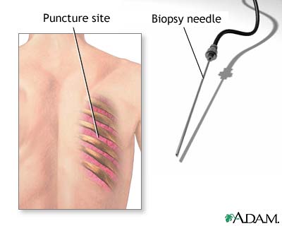 Lung biopsy