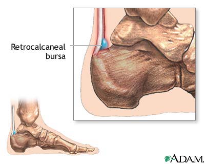 Retrocalcaneal bursitis