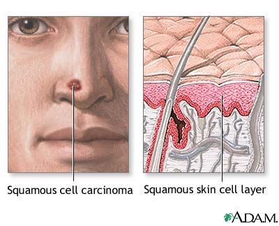 Squamous cell cancer