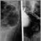 Rectal cancer, X-ray