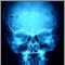 Eosinophilic granuloma - X-ray of the skull