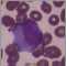 Infectious mononucleosis #3