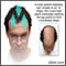 Male pattern baldness