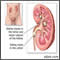 Nephrolithiasis