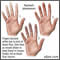 Raynaud's phenomenon