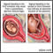 Vaginal bleeding during pregnancy